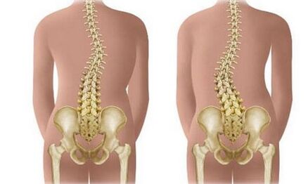 Scoliosis bukan presistant