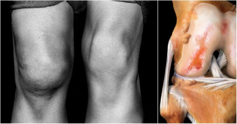 Osteoarthritis sendi lutut dan sendi kesakitan