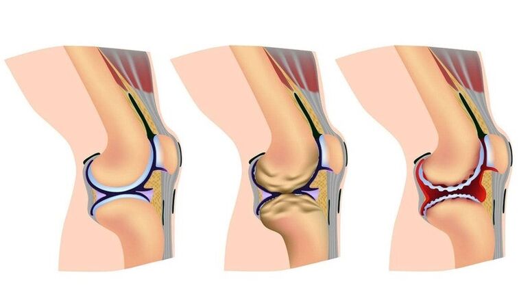 Tahap ubah bentuk di sendi lutut ke arthrosis