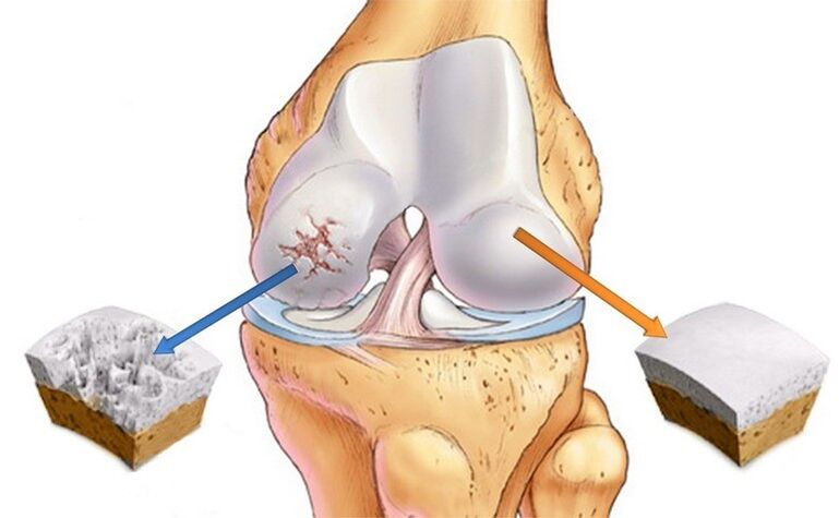 rawan biasa dan osteoarthritis