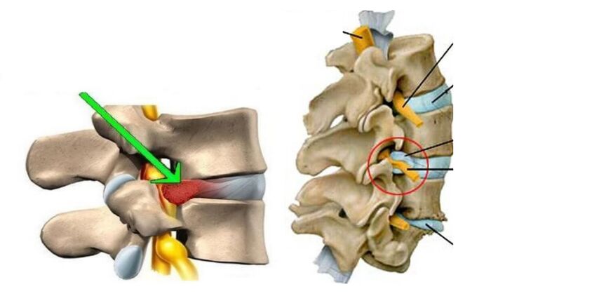 Sakit belakang bawah kerana cakera herniated