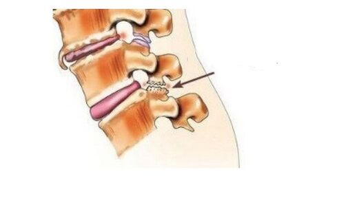 Spondyloarthrosis menyebabkan sakit belakang
