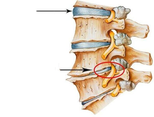 cakera intervertebral biasa dan rosak di tulang belakang