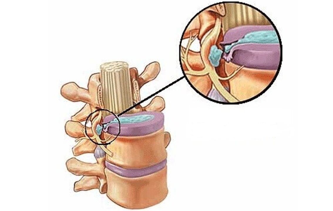 Hernia intervertebral dengan osteochondrosis toraks