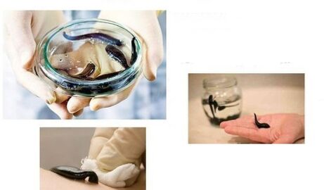 Hirudoterapi untuk osteoarthritis