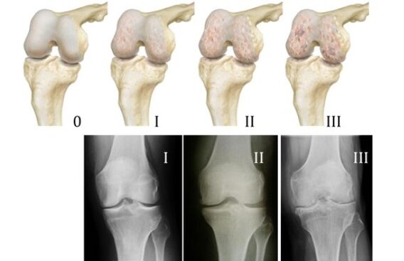 Kaedah untuk mendiagnosis osteoarthritis lutut