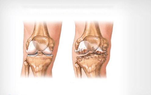 Osteoartritis sendi lutut