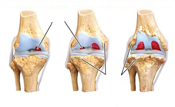 Peringkat osteoarthritis lutut